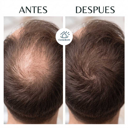 Aceite Capilar Anti Caída - Fortalece la raíz del cabello - Frena la caída antes de que sea tarde