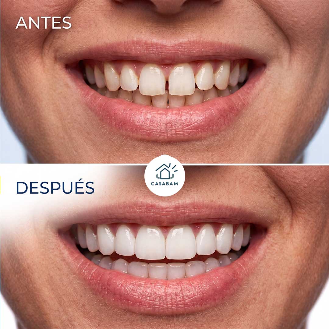 Carillas Dentales - Cubren imperfecciones dentales - Sonríe con confianza en segundos, sin pisar el dentista