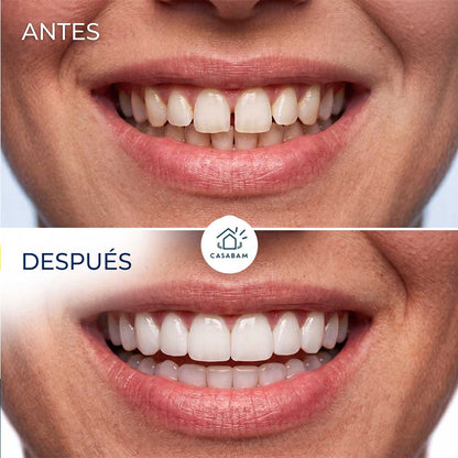 Carillas Dentales - Cubren imperfecciones dentales - Sonríe con confianza en segundos, sin pisar el dentista