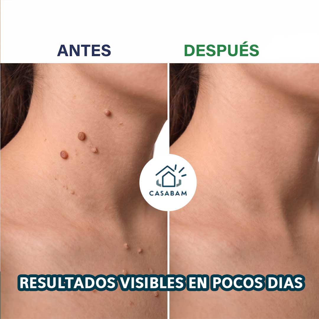 Crema eliminadora de verrugas, piel sin dejar marcas - Recupera tu confianza: piel limpia sin que nadie sepa que tuviste una verruga