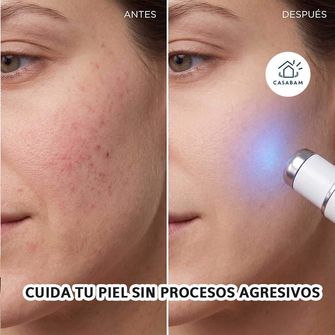 Pluma terapia de luz azul - Trata imperfecciones de la piel al instante - Rostro liso y libre de manchas, sin salir de casa