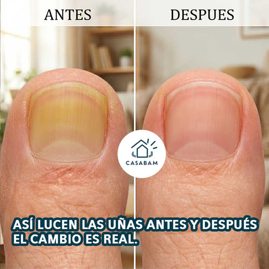 Tónico Jengibre Elimina hongos - Recupera uñas bonitas y saludables - y vuelve a mostrar tus pies con confianza.